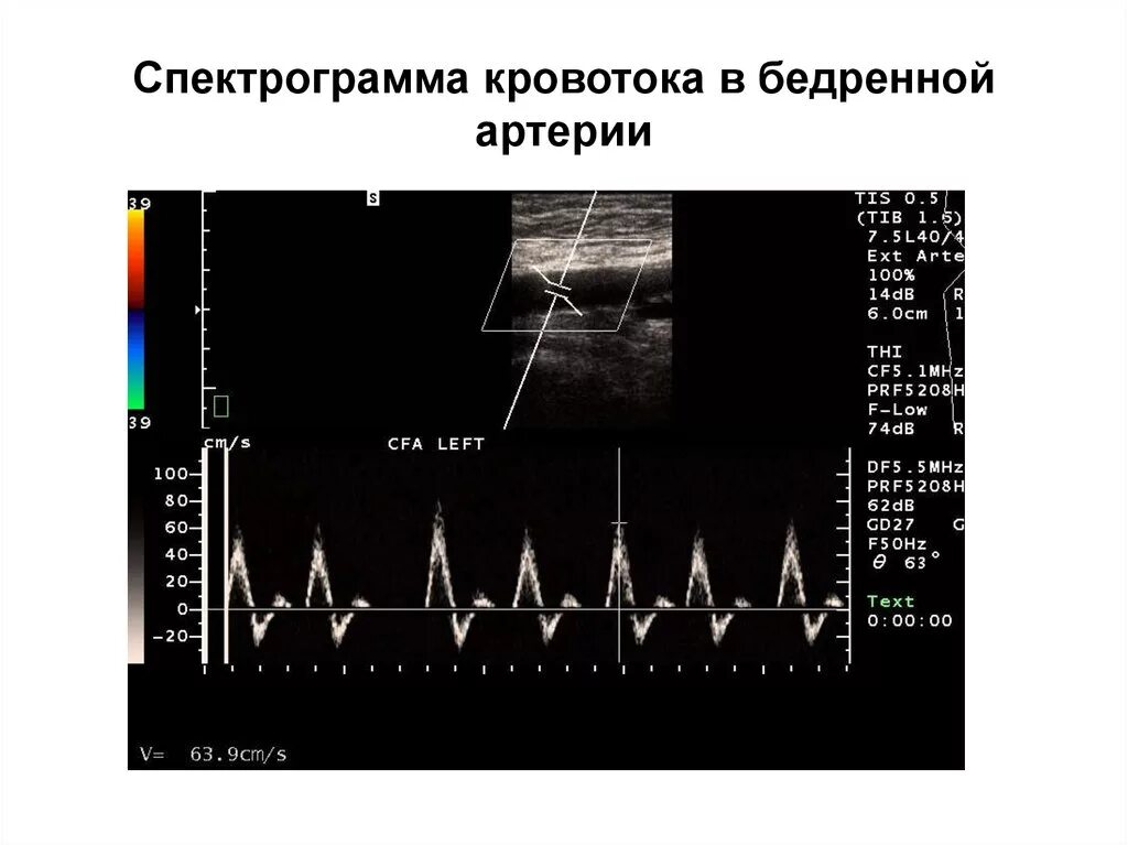 Доплер конечностей. Норма ультразвуковых исследований артерий нижних конечностей. Допплерография, спектр кровотока. УЗИ артерий нижних конечностей нормальные показатели. УЗИ подключичной артерии.