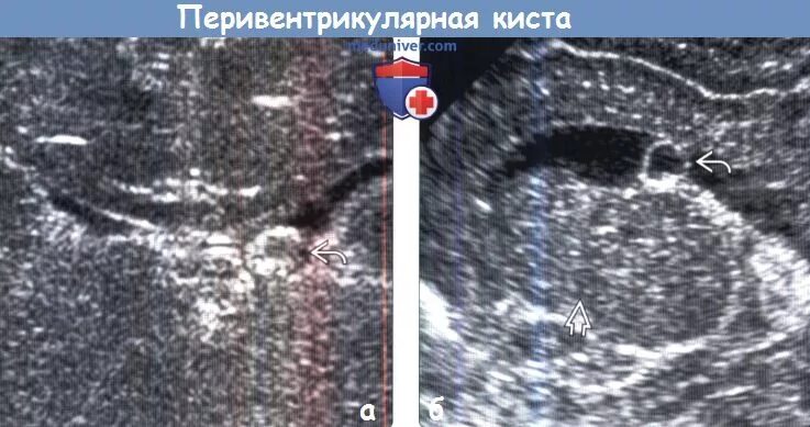 Субэпендимальные кисты на УЗИ. Хориоидальная киста на УЗИ. Арахноидальная киста на УЗИ. Субэпендимальная киста НСГ.