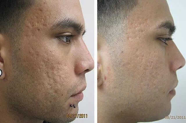 Микронидлинг постакне. Под кожу с помощью. Под кожу с помощью. Выдававливание прыщей. Под кожу с помощью.