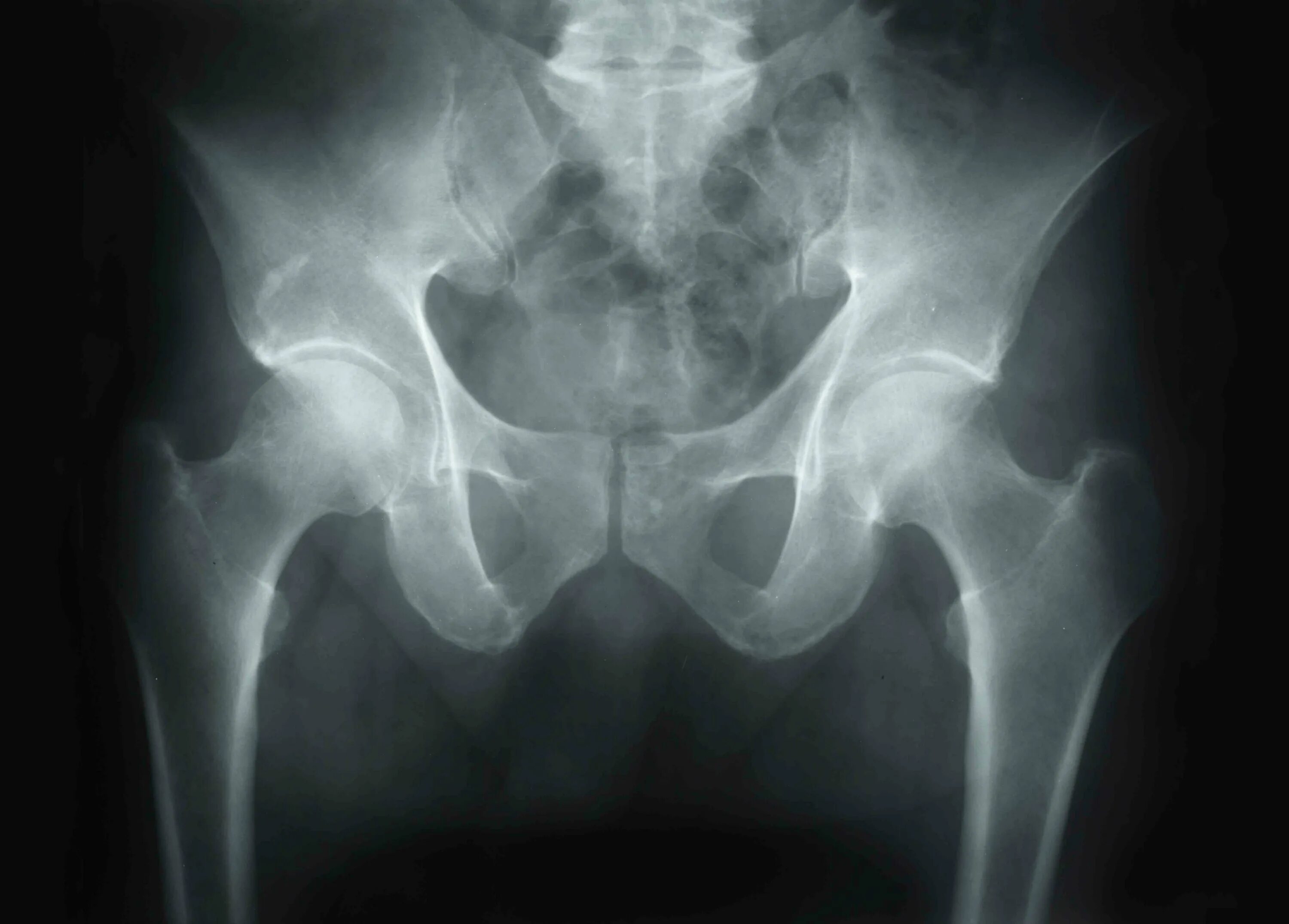Асептический некроз кости. Некроз кости тазобедренного сустава. Асептический некроз коленного сустава рентген. Аваскулярный некроз головки бедренной кости.