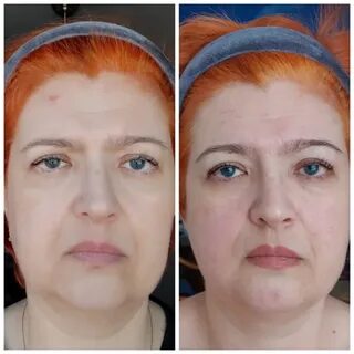 Скульптурный массаж до и после