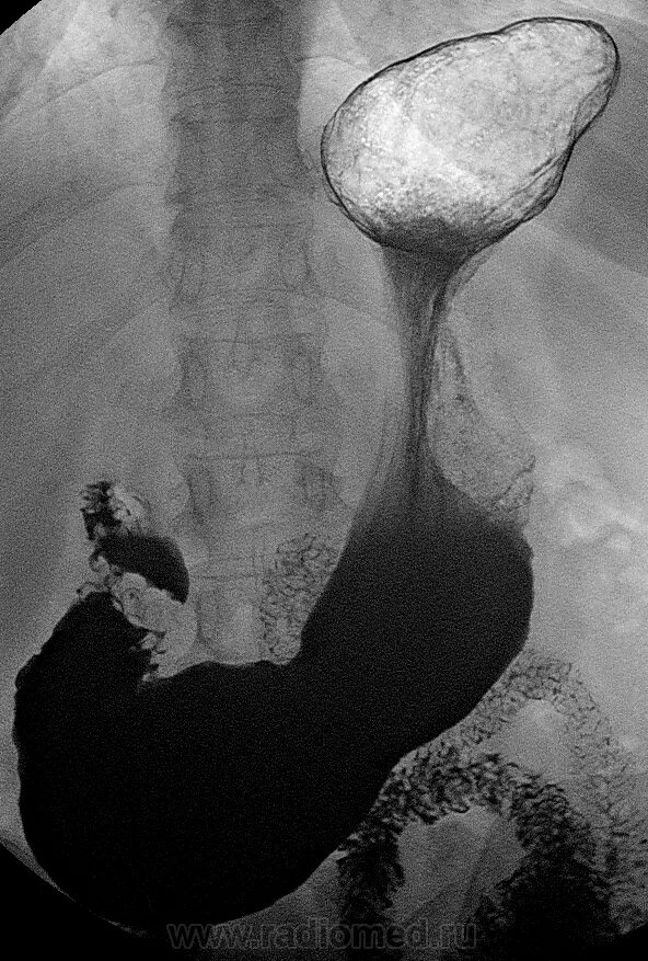 Рентгенография пищевода желудка и ДПК. Рентгеноконтраст желудка. Рентгеноскопия желудка на трохоскопе что это такое. Скопия пищевода желудка