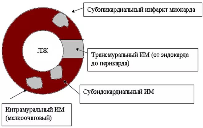 Универсальная классификация инфаркта миокарда. Инфаркт миокарда классификация по слоям. Виды миокарда. Периоды инфаркта миокарда. Критерии инфаркта миокарда 2 типа.