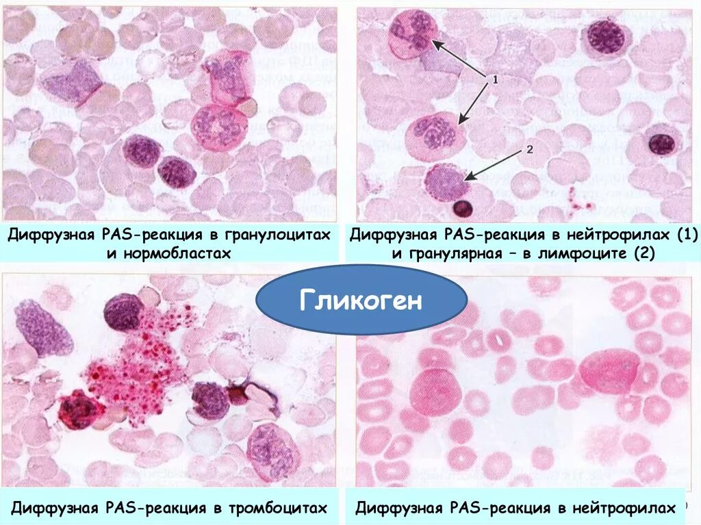 Диффузный анализ. Pas реакция положительная. Реакция на гликоген при лейкозах. Реакция на гликоген положительная. Гранулярная pas-реакция.