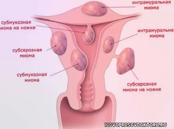 Классификация миомы матки по размерам в сантиметрах. Миома 6 недель размер в см. Размер миоматозных узлов. Размер миоматозных узлов. Интрамуральный узел в матке что это.
