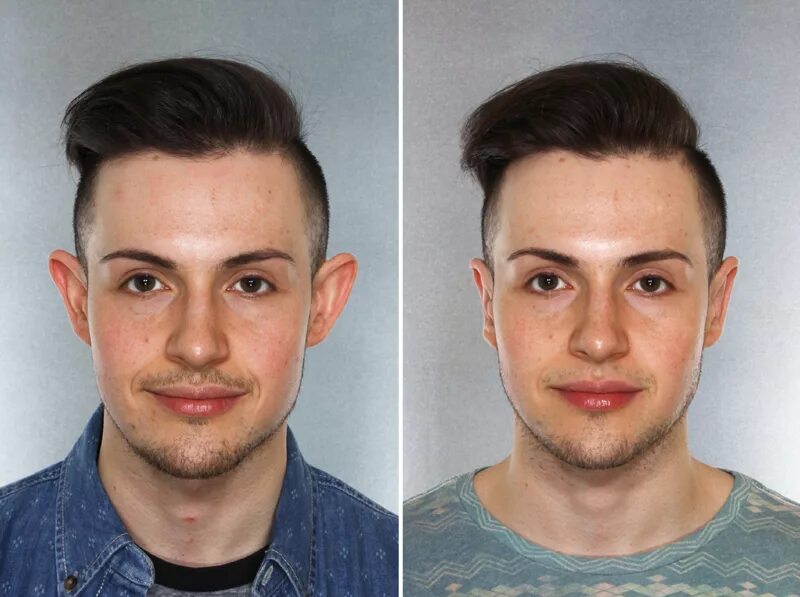 Как сделать чтобы уши не торчали. Короткие стрижки при лопоухости. Отопластика (пластика ушных раковин. Лопоухость фото. Пластика ушей лопоухость.