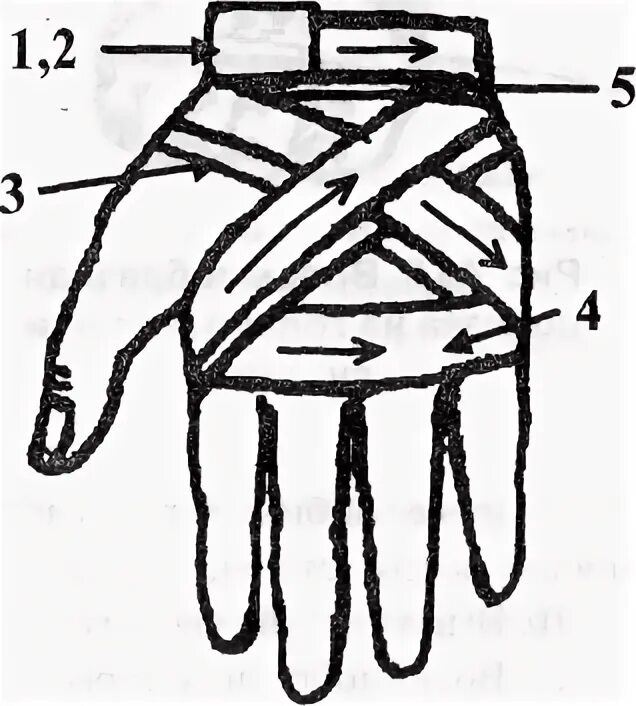 Техника наложения повязки перчатка