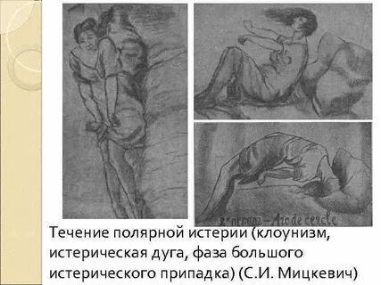 Признак истерического приступа