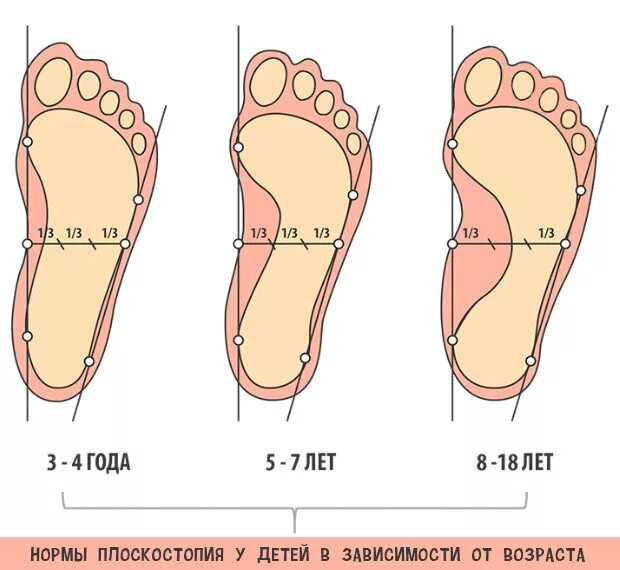 Ребенку год плоскостопие