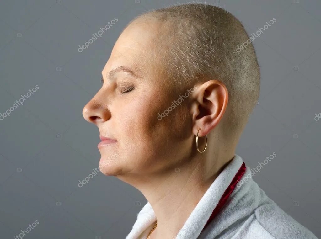 волосы после химиотерапии. химиотерапия облысение. лысые женщины. химиотерапия облысение. химиотерапия облысение.