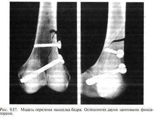 Остеосинтез мыщелка бедренной кости. Перелом мыщелка остеосинтез. Остеосинтез коленного сустава. Переломы мыщелков бедра остеосинтез. Остеосинтез мыщелка
