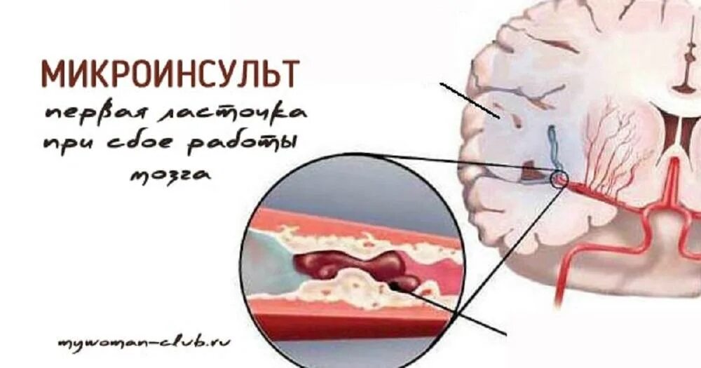 Поражение стволового мозга ишемический инсульт. Поражение ствола мозга при инсульте. Поражение ствола головного мозга при инсульте ишемическом. Ишемический инсульт ствола головного мозга последствия. Головной микроинсульт