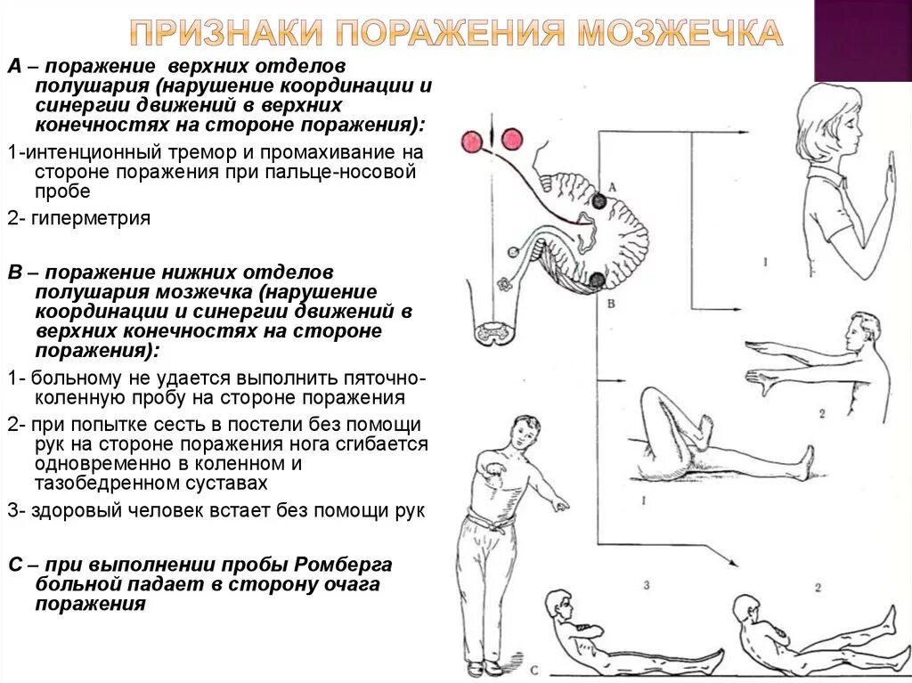 Нарушается координация движения. Симптомы поражения мозжечка неврология. Поражение полушарий мозжечка симптомы. Клинические симптомы поражения мозжечка. Нарушение функций мозжечка симптомы.