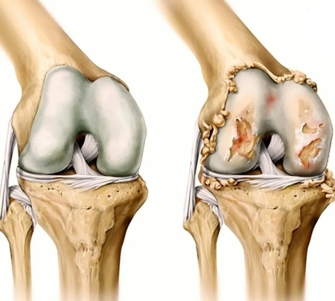 Гонартроз остеоартроз. Деформирующий остеоартроз (доа). Деформирующий остеоартроз поражение суставов. Коленный сустав производители
