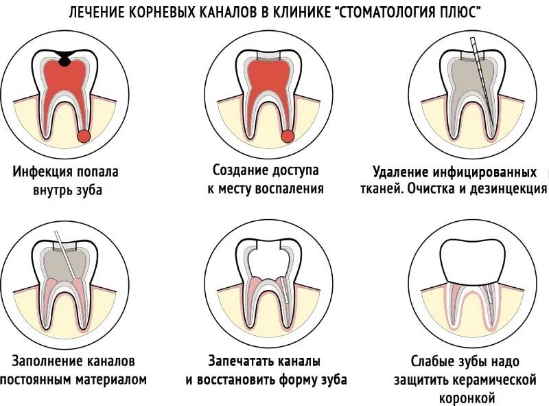 1 корневой канал. Лечение корневых каналов. Каналы в зубах схема.