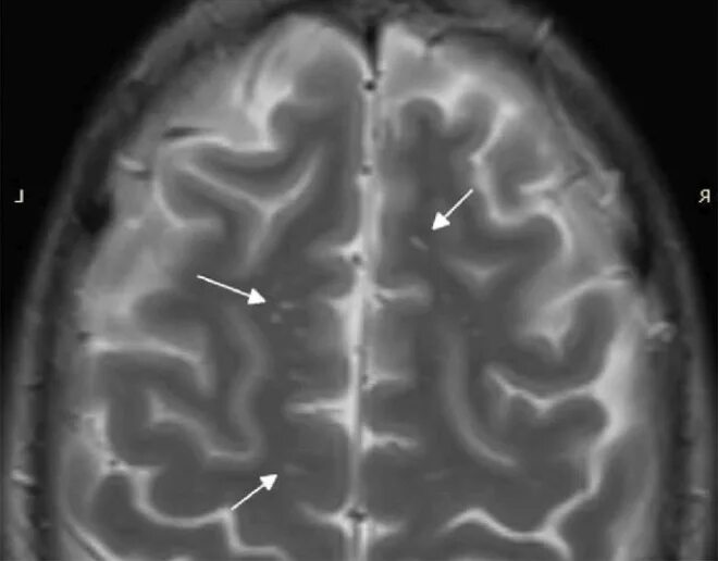 Множественный глиоз мозга. Глиоз в головном мозге на мрт. Кортикальный глиоз. Глиозные очаги головного мозга мрт. Очаги глиоза на мрт.