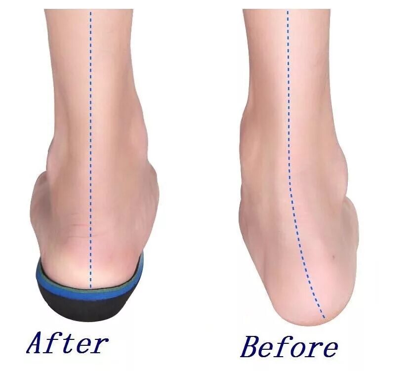 вальгус про фиксатор для большого пальца. искривление ног аппарат илизарова. корректор для большого пальца valgus pro (вальгус про). выровнять стопу. лфк вальгус.