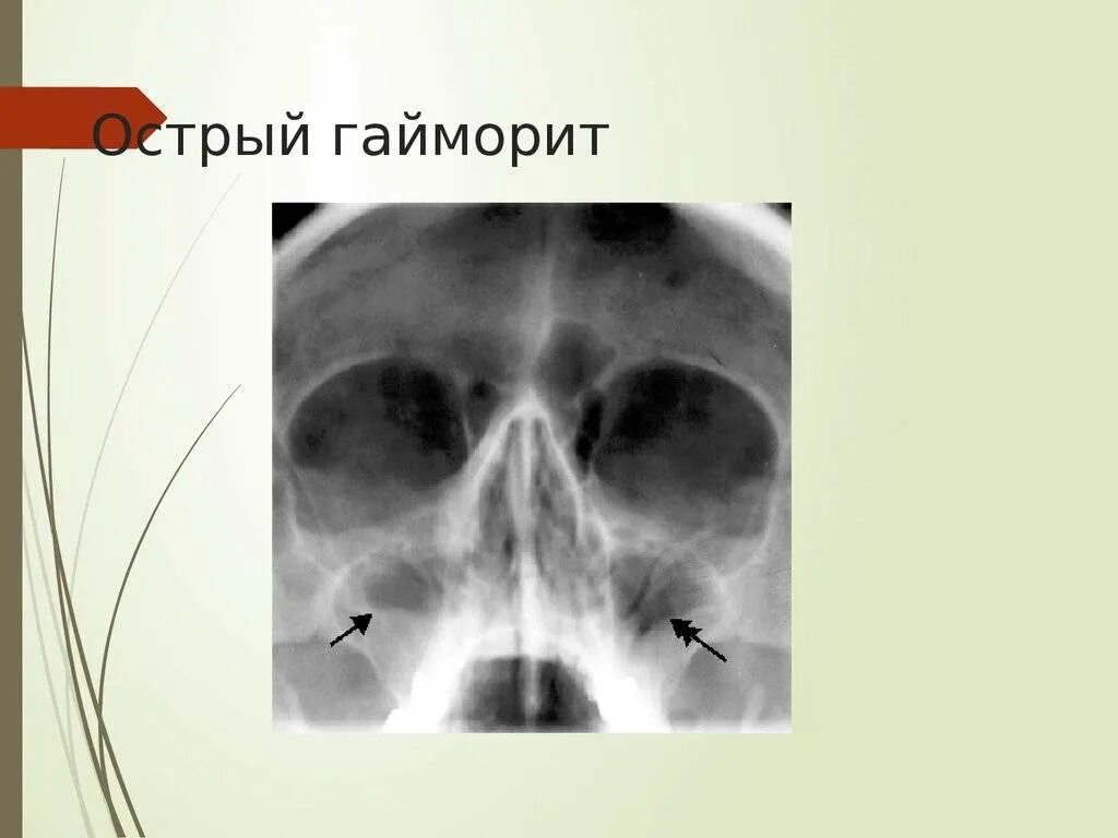 Двухсторонний верхнечелюстной синусит у ребенка. Острый гнойный катаральный риносинусит. острый катаральный синусит. перфорация гайморовой пазухи. острый двухсторонний гнойный риносинусит.