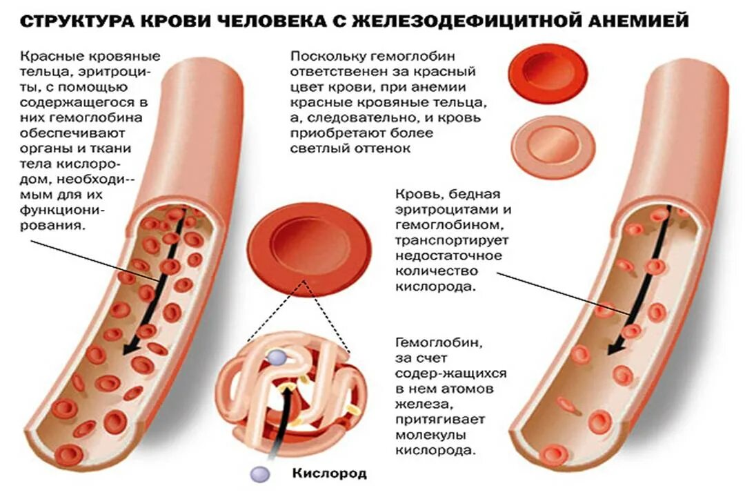 Анемия железа. Анемия низкий гемоглобин. Развитие железодефицитной анемии.