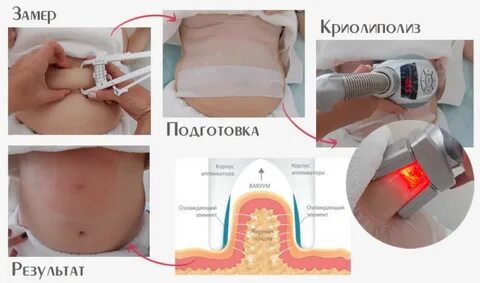 Криолиполиз что это такое отзывы