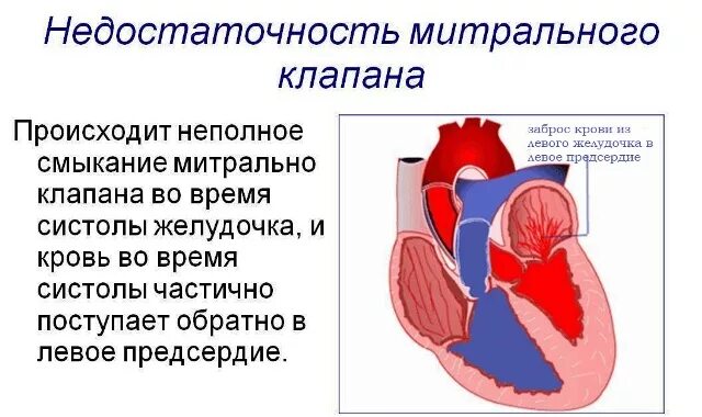 Сердечная недостаточность митрального клапана. Пороки сердца недостаточность митрального клапана. Недостаточность двустворчатого (митрального) клапана. Недостаточность митрального клапана структура. Приобретенный порок сердца митральная недостаточность.