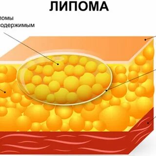 Лечение жировика народными