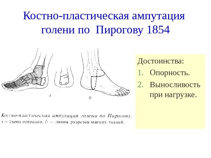 Пирогов костно-пластическая ампутация голени. Костно пластическая ампутация голени по Пирогову. Костнопластическая ампутация пирогов. Костно пластическая операция голени по Пирогову.