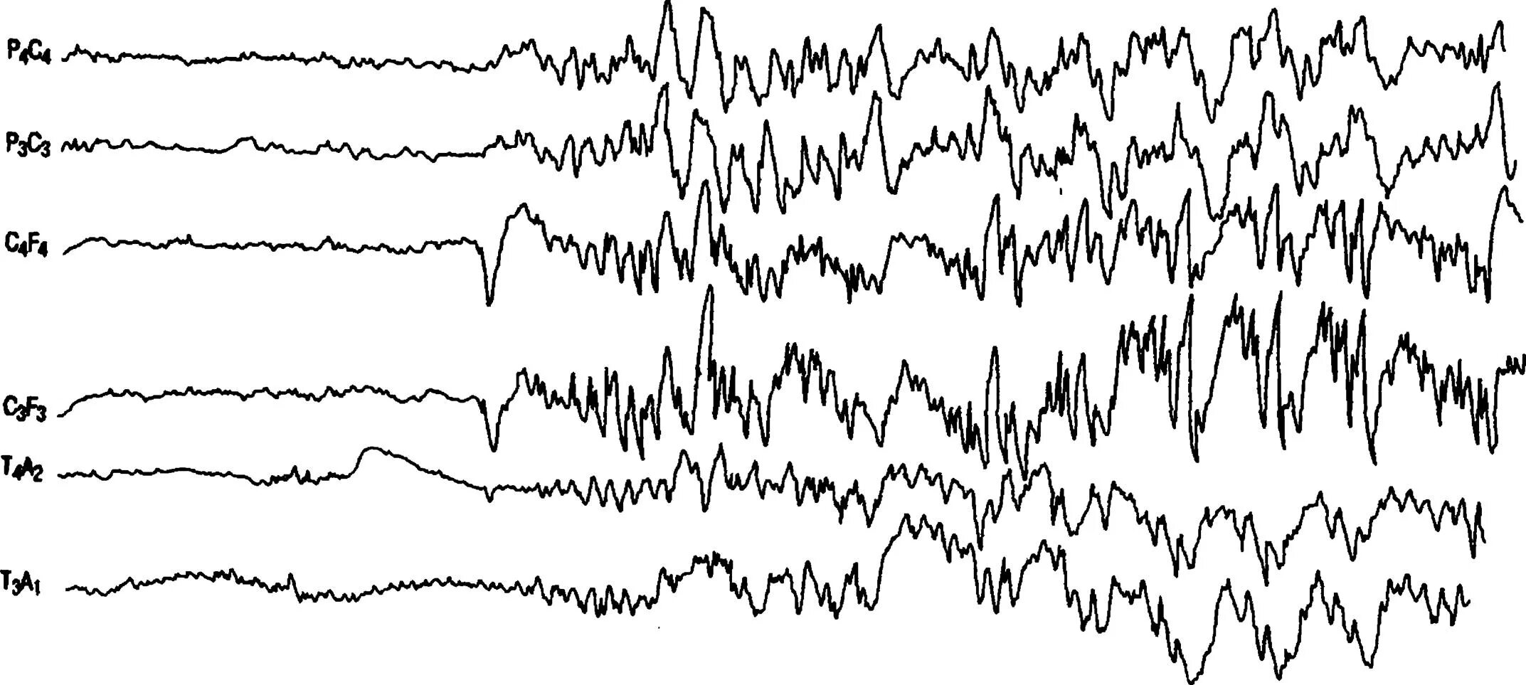 Низкоамплитудная ээг. ЭЭГ 50 МКВ. Калибровочный сигнал ЭЭГ. Тау ритм ЭЭГ. Вертекс волна ЭЭГ.