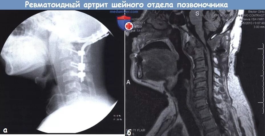 Ревматоидный артрит позвоночника мрт. Артрит шейных позвонков. Ревматоидный артрит спина. Ревматоидный артрит поясничного отдела позвоночника. Спондилит поясничного отдела позвоночника мрт.