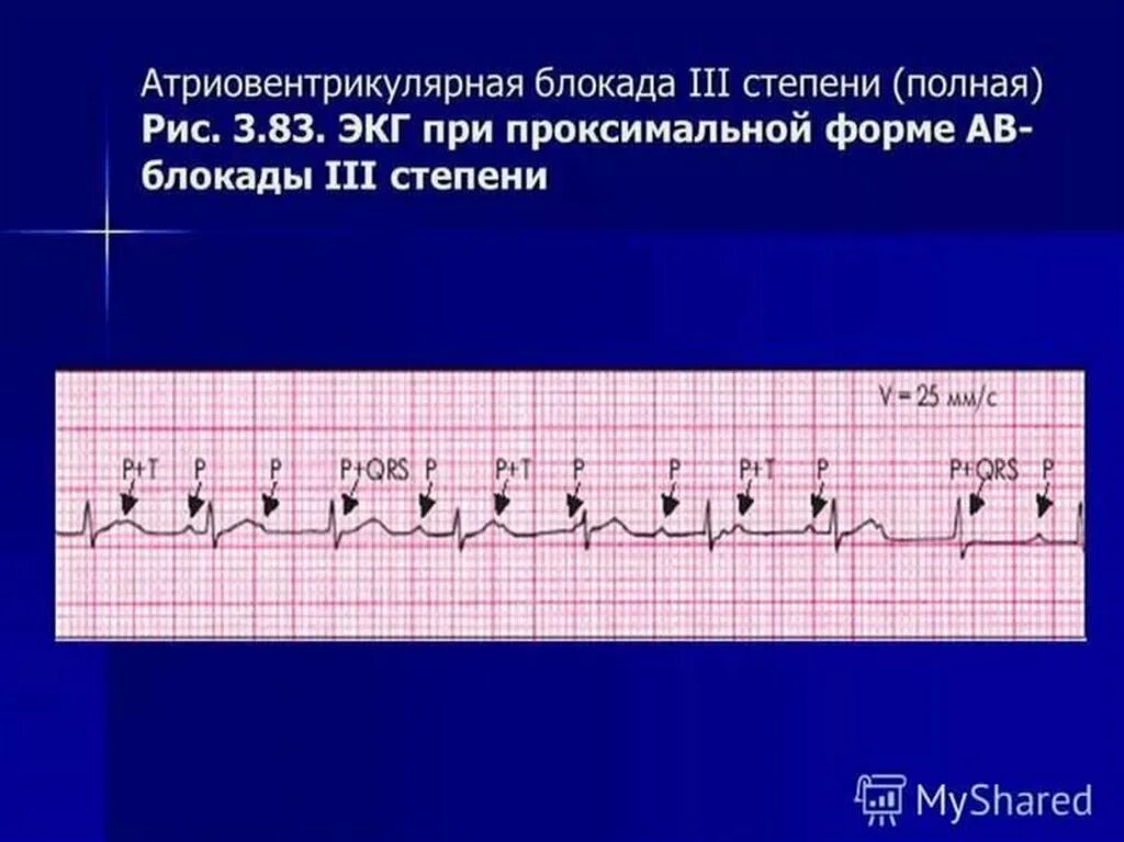 Что значит полная блокада. Полная атриовентрикулярная блокада 3 степени на ЭКГ. ЭКГ при атриовентрикулярной блокаде 3 степени. Атриовентрикулярная блокада i степени на ЭКГ. Аб блокада 3 степени ЭКГ.