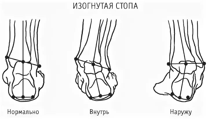 Стопы внутрь