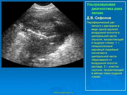 Узи грудной клетки