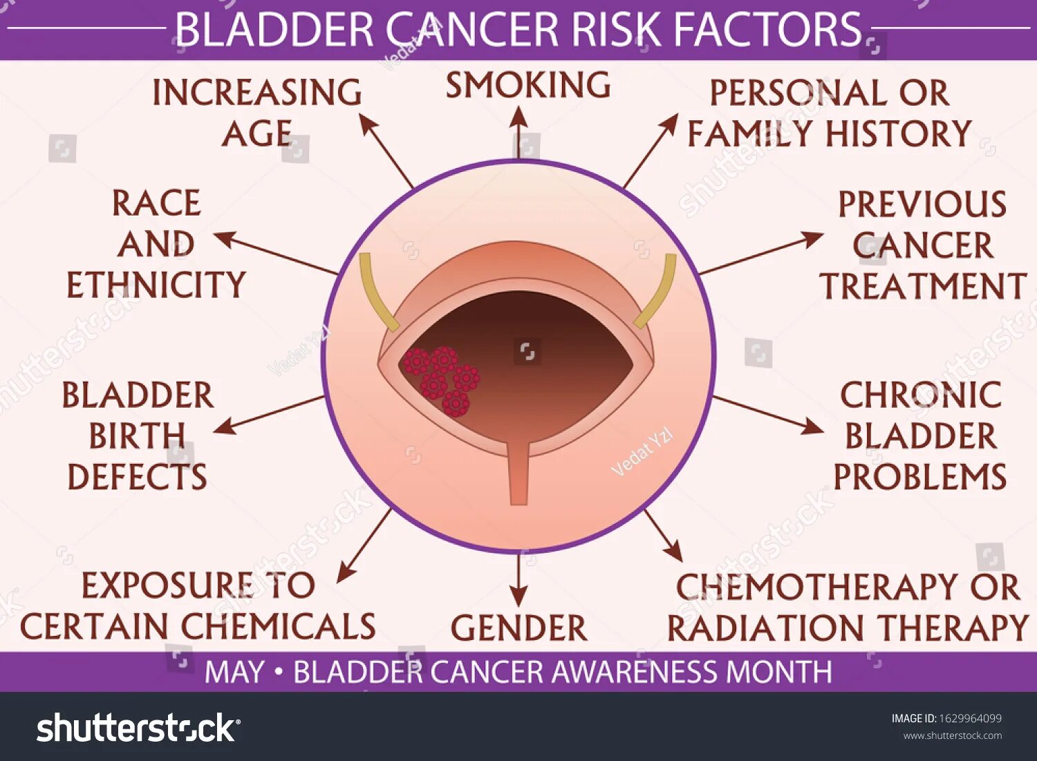 Размер опухоли мочевого пузыря по стадиям. Prostate Cancer risk Factors. Статистика распространенности опухолей мочевого пузыря 1000 населения. Моча при раке мочевого