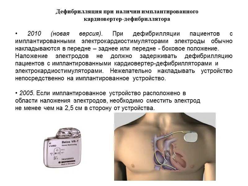 Дефибрилляция наложение. Наложение электродов дефибрилляции электродов. Кардиовертер-дефибриллятор. Кардиостимулятор дефибриллятор.