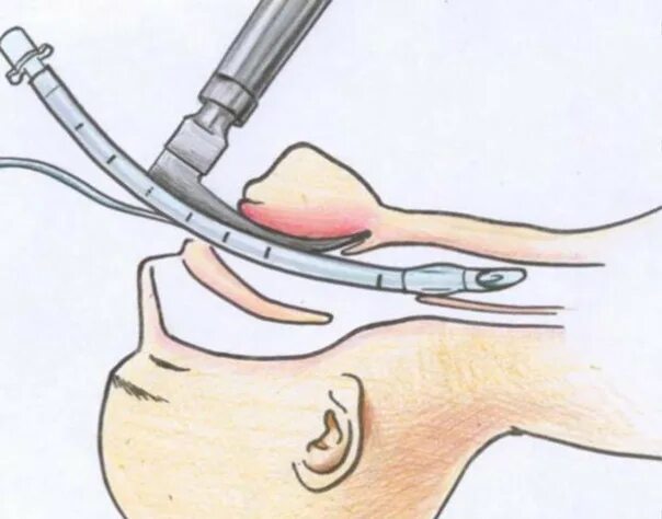 Эндотрахеальный наркоз интубация. Ретроградная интубация трахеи. Трахеостомия обезболивание. Трубка во время операции