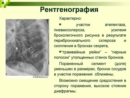 Что такое пневмофиброз легких простыми словами