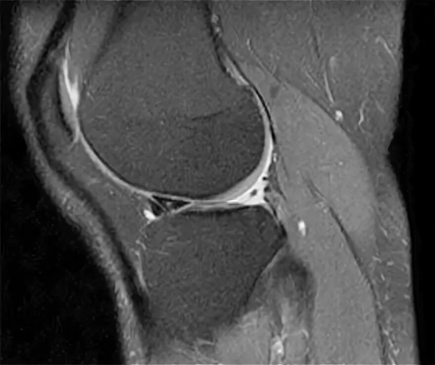 Разрыв латерального мениска. Повреждение мениска коленного сустава рентген. Разрыв мениска рентгеновском снимке. Повреждение мениска на рентгене.