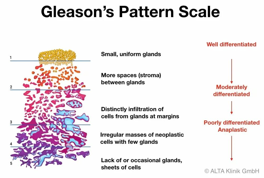 Глисон простата. Gleason Grade. Gleason score. Глисон шкала.