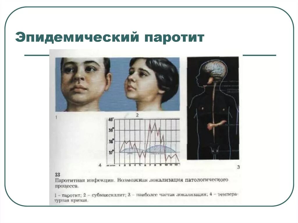 Паротит клиника. Эндемический паротит клиника. Эпидемический паротит. Осложнения при эпидемическом паротите.