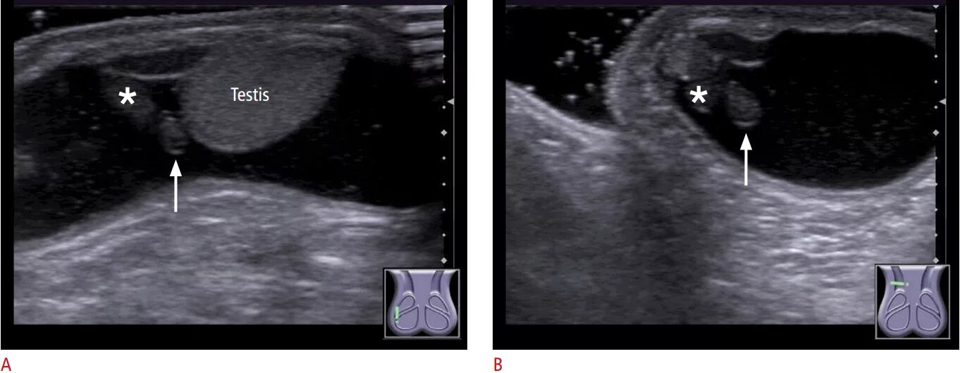 Перекрут гидатиды яичка. УЗИ признаки перекрута яичка.
