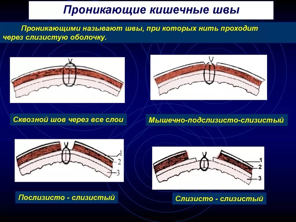 Классификация кишечного шва. Хирургические швы кишечные. Как называется шов после операции