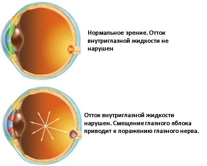 Глазное давление при катаракте. Глаукома, повышенное внутриглазное давление. Нарушение оттока внутриглазной жидкости симптомы. Повышение внутриглазного давления.