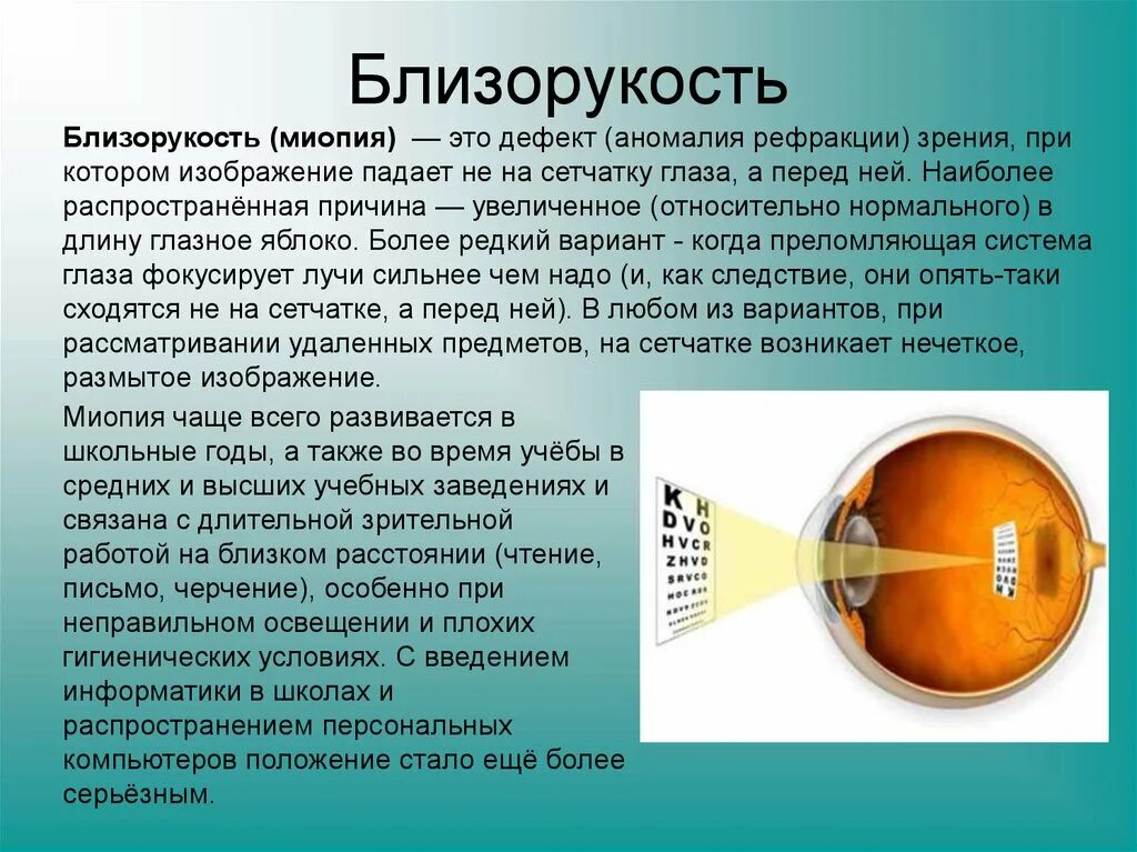 Болезнь дальнозоркость. Близорукость. Близорукость миопия. Заболевание глаз миопия. Заболевание органов зрения миопия.