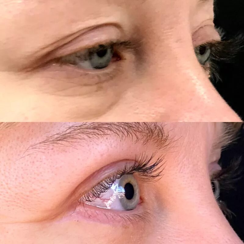 аугментационная ринопластика. пластика носа. лазерный блефаролифтинг век. пластика нижних век (блефаропластика) (нижняя). пластика нижних век (блефаропластика) (нижняя).