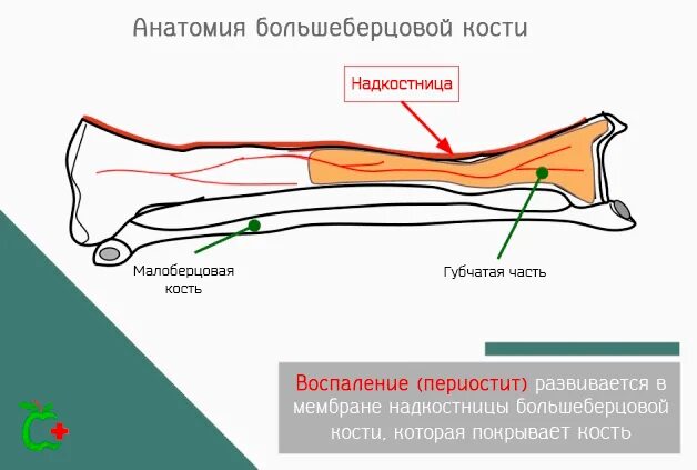 Болит большая берцовая. Периостит надкостницы большеберцовой кости. Периостит костей голени. Воспаление надкостницы большеберцовой кости. Периостит берцовой кости.