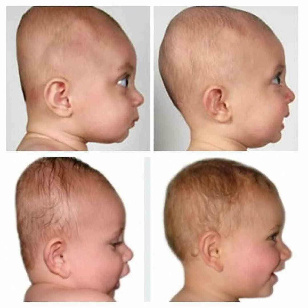 Коррекция краниосакральная костей черепа. Сагиттальный краниосиностоз скафоцефалия. Исправление черепа. Кривошея плагиоцефалия. Врожденная кривошея-плагиоцефалия.