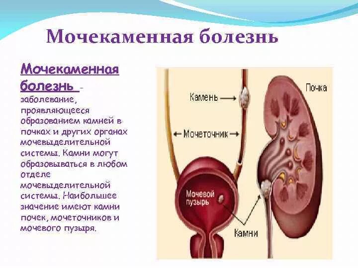 Заболевания мочеполовой системы мочекаменная болезнь. Инфекция мочевой системы. Заболевания выделительной системы. Заболевания органов мочевой системы.