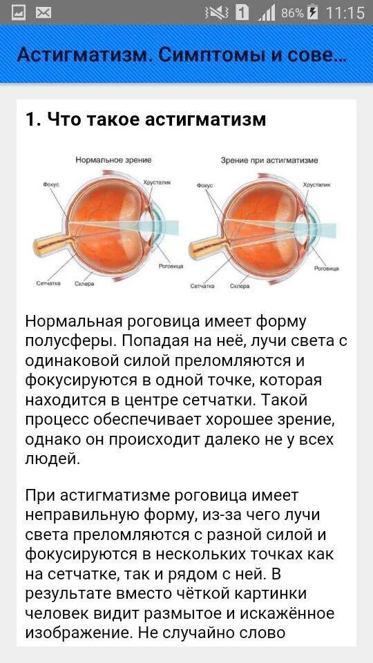 Дальнозоркий астигматизм у детей. Миопический роговичный астигматизм. Смешанный миопический астигматизм. Гиперметропический астигматизм у детей. Сложный гиперметропический астигматизм глаз