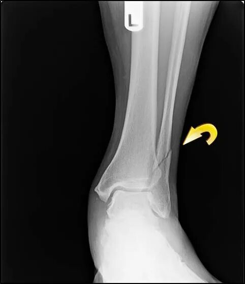 Малая берцовая кость перелом. Краевой оскольчатый перелом малоберцовой кости. Перелом голени и малоберцовой кости. Перелом малоберцовой кости без смещения рентген.