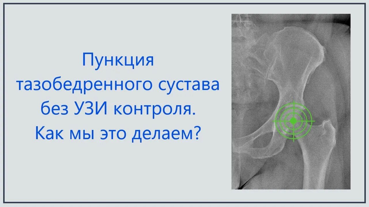 Пункция тазобедренного сустава техника. Пункция тазобедренного сустава под УЗИ. Блокада тазобедренного сустава. Блокада тазобедренного сустава при коксартрозе. Пункция тазобедренного сустава техника выполнения. Пункция тазобедренного сустава техника. Пункция тазобедренного сустава под УЗИ. Блокада тазобедренного сустава. Блокада тазобедренного сустава при коксартрозе.